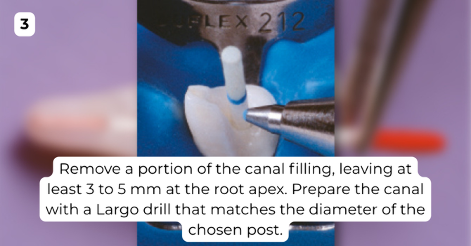 Angelus Reforpost Glass Fiber - Ref. 726 (image 5 of 10)
